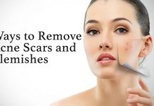 Ways to Remove Acne Scars and Blemishes That Work for Me!