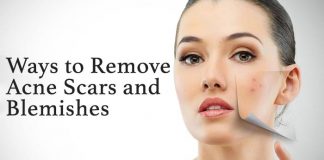 Ways to Remove Acne Scars and Blemishes That Work for Me!