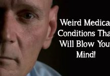Weird Medical Conditions That Will Blow Your Mind!