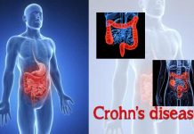 Crohn’s Disease : Types, Causes, Symptoms and Treatment