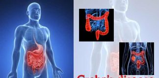 Crohn’s Disease : Types, Causes, Symptoms and Treatment