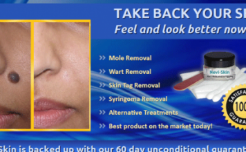 Nevi Skin Wart & Mole Removal : For Flawless & Spotless Skin